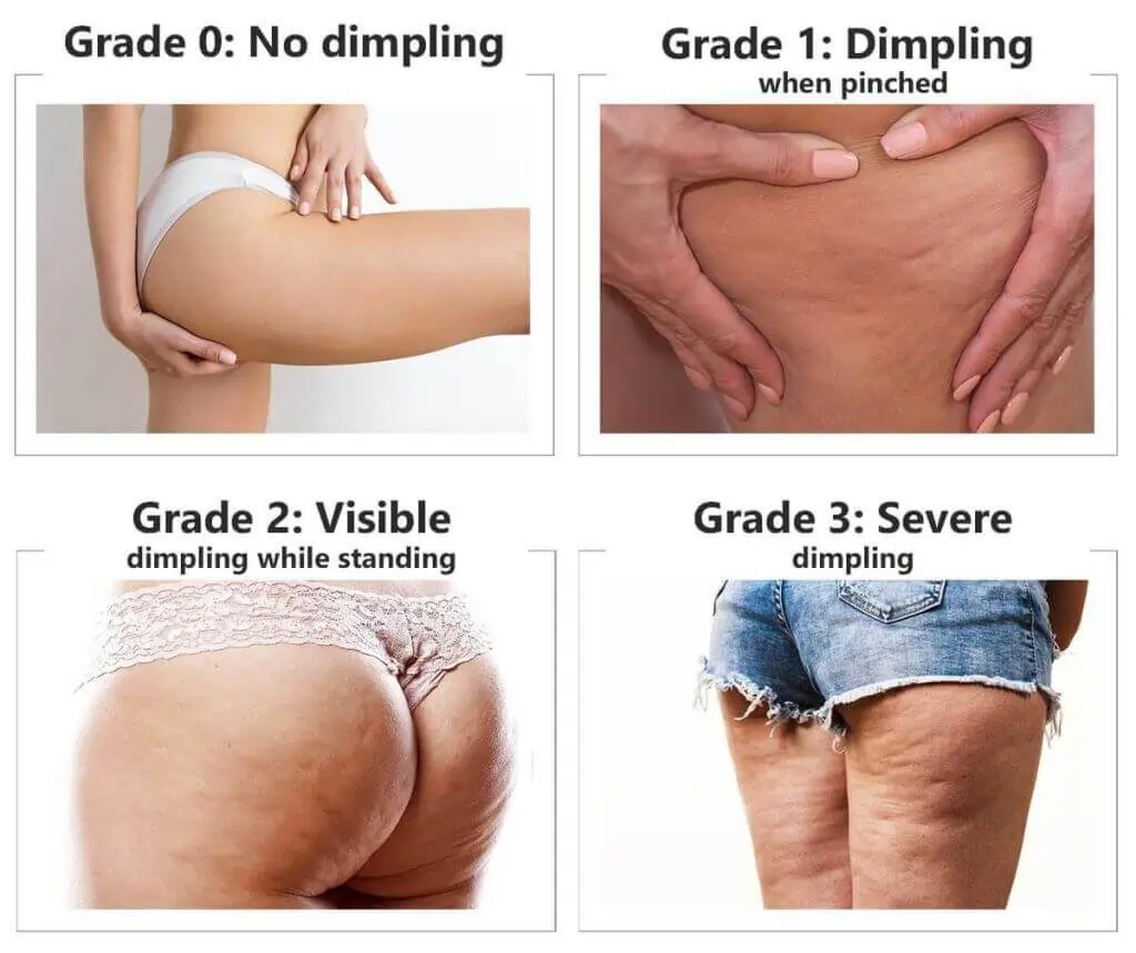 Representation of the stages of cellulite development Addlestone